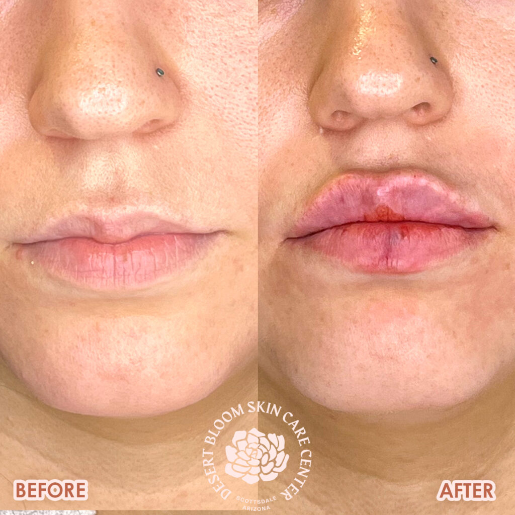 lip filler before and after