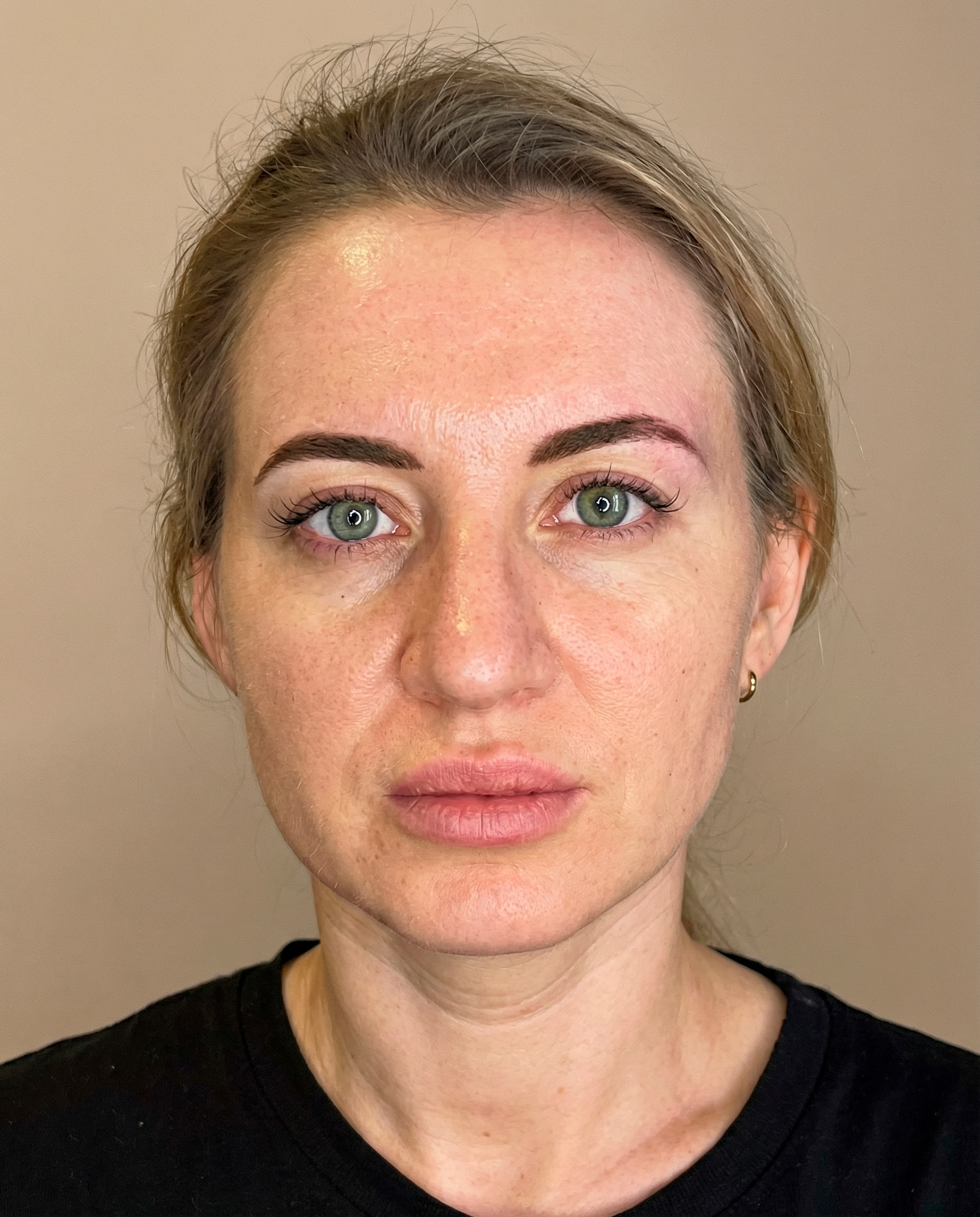 Thread lift case study — 37-year-old female patient before treatment for facial fatigue at Desert Bloom Scottsdale