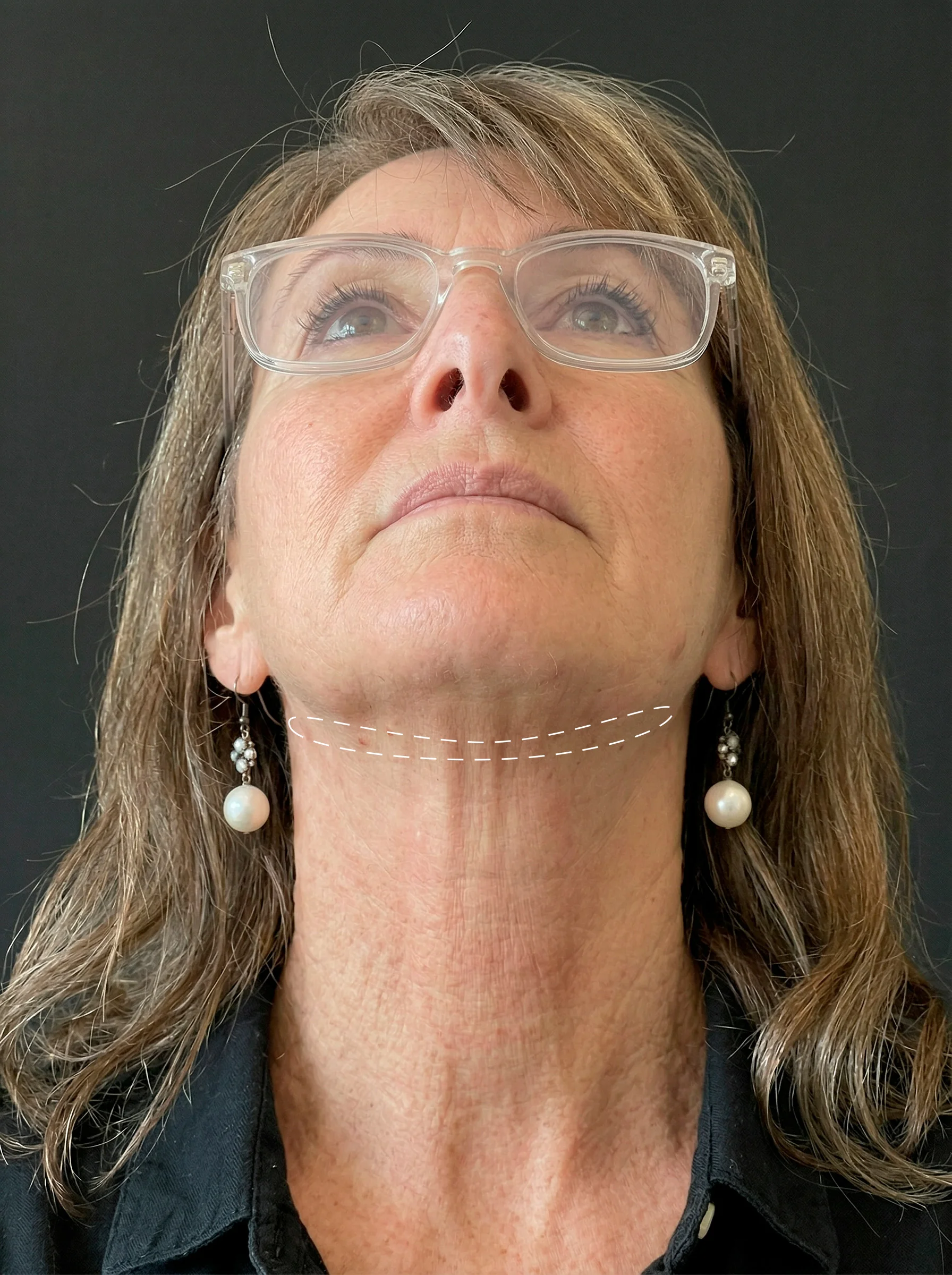 Insertion points for a PLLA thread sling targeting sagging neck skin and submental laxity.