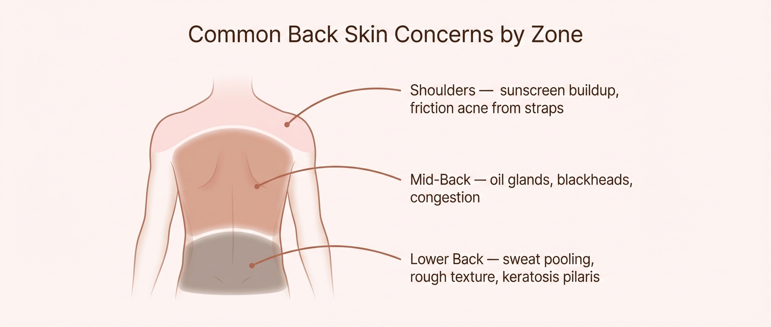 Back facial treatment zones — shoulders mid-back and lower back skin concerns